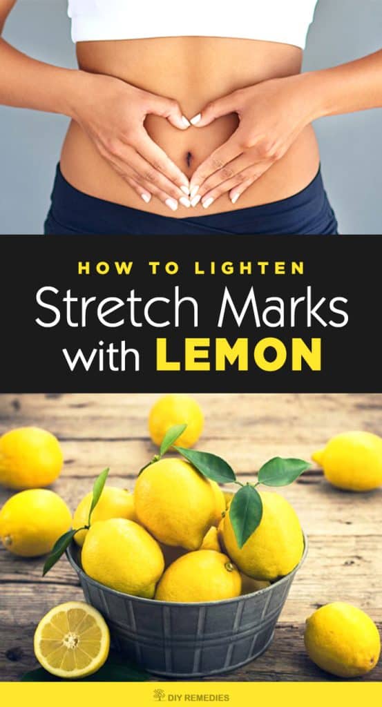 best product to lighten stretch marks