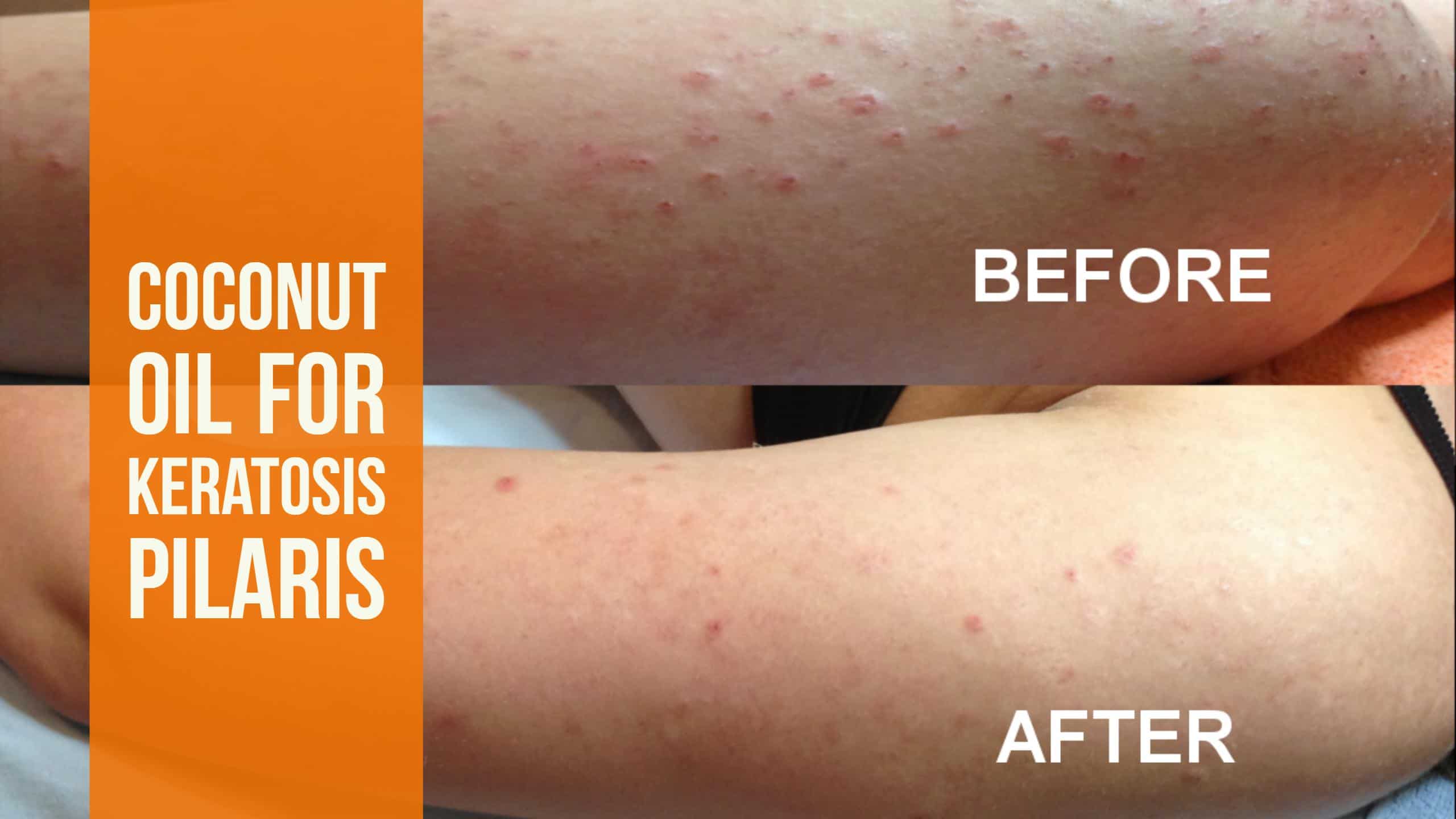 Treating Keratosis Pilaris with Coconut Oil