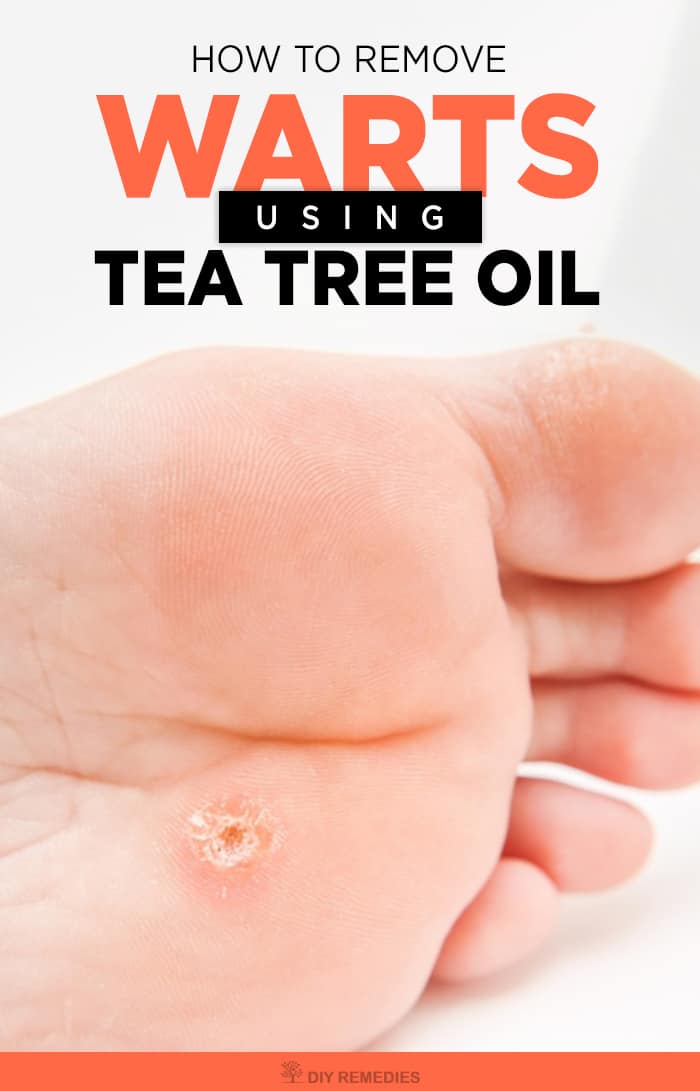 How to Remove Warts using Tea Tree Oil