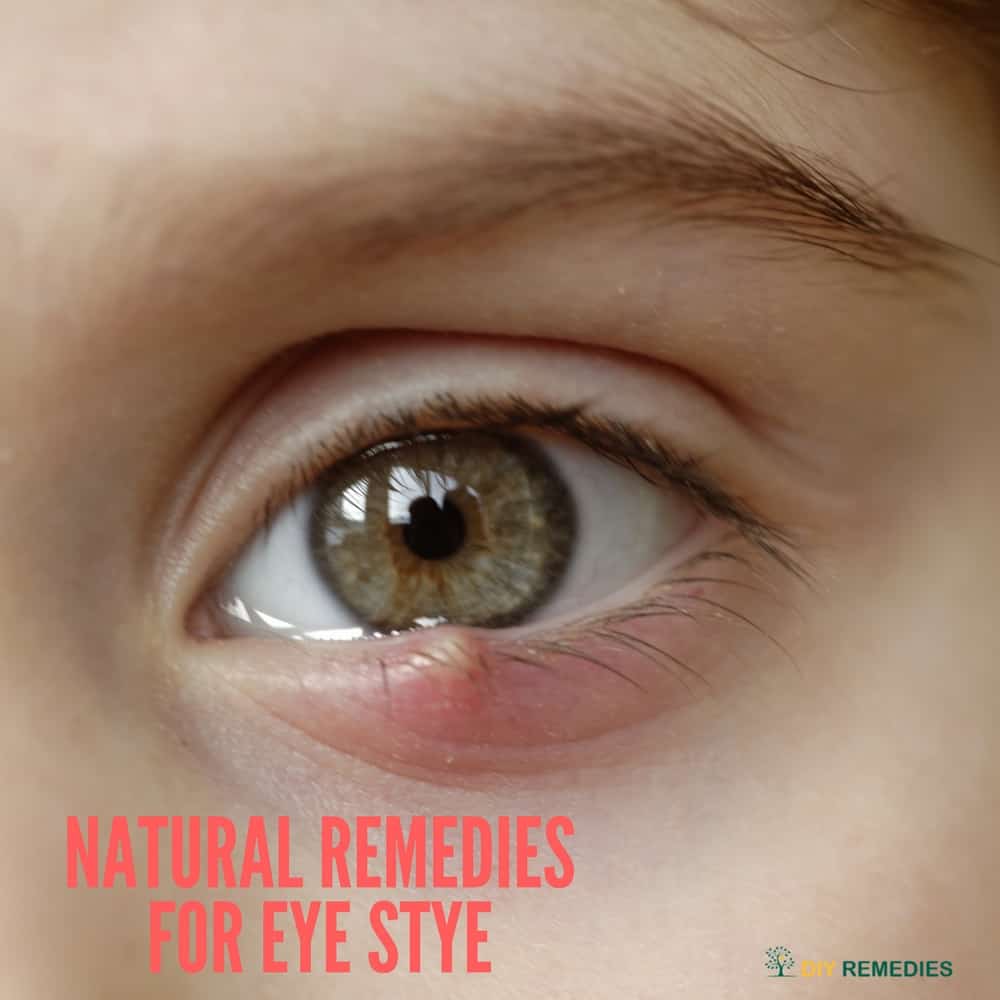 Natural Remedies for Eye Stye
